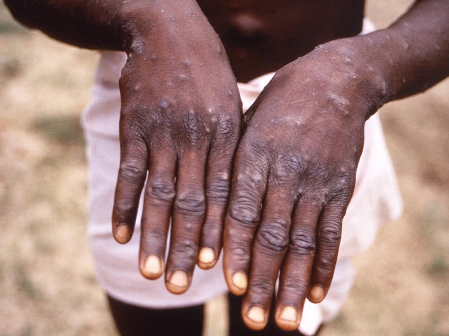 Variole du singe : l’OMS déclare une urgence de santé publique de portée internationale